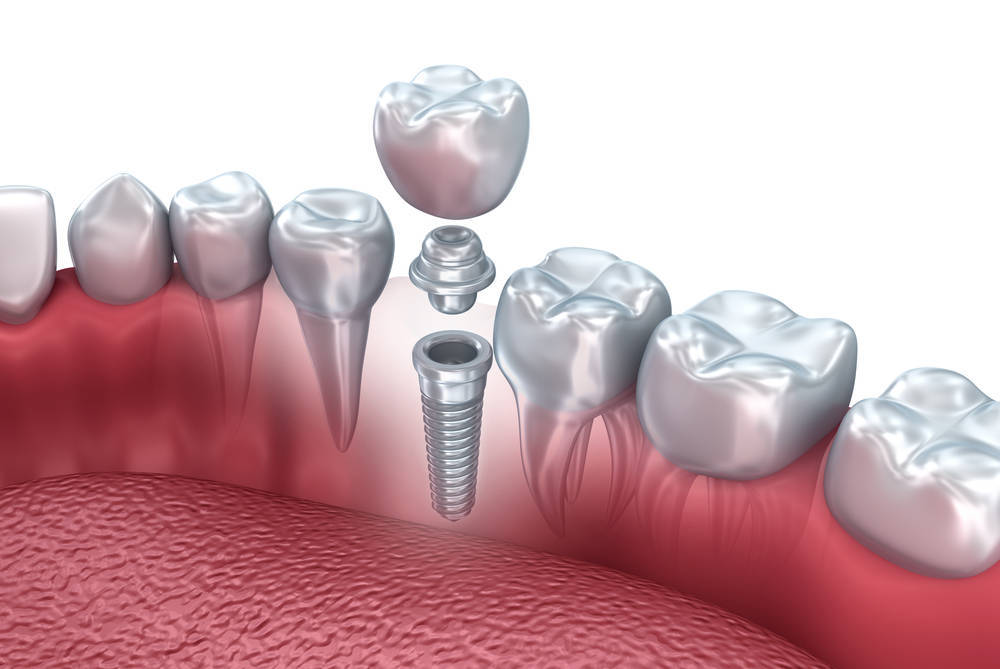 Llega la tecnología 3D al mundo dental